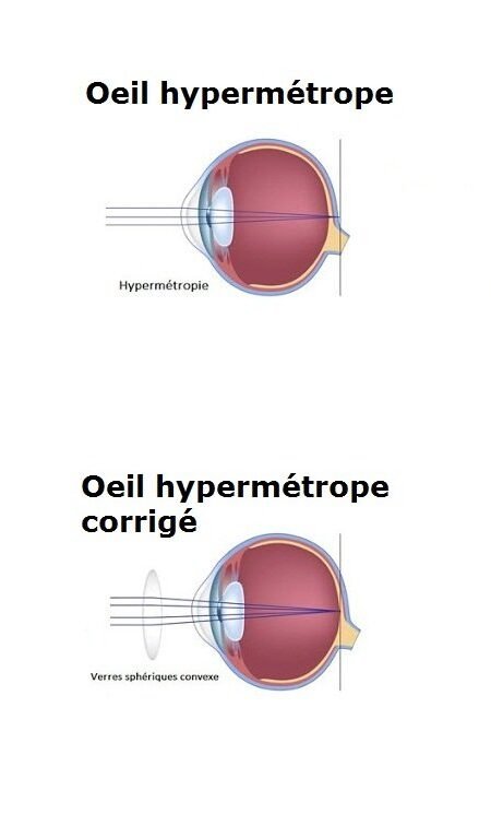 Oeil Hypermetrope